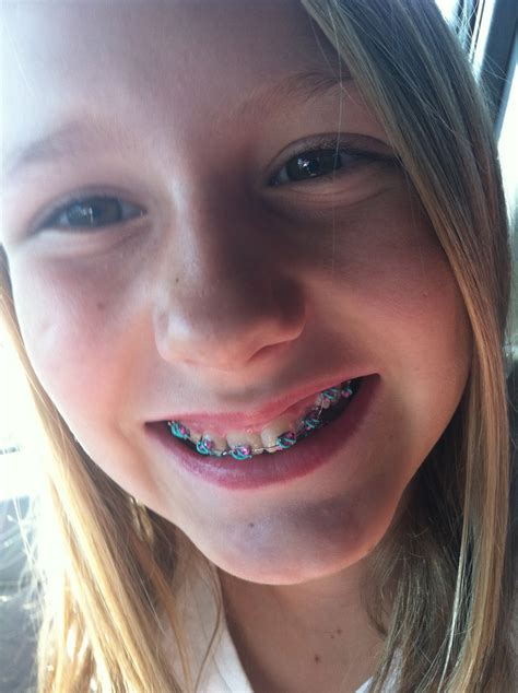 girl with braces leaked|Brace Face